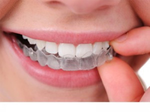 doorzichtige beugel Invisalign Enschede