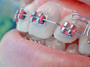 slotjesbeugel TOP Orthodontie